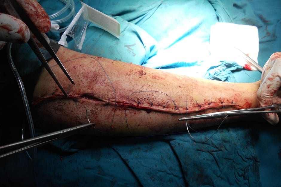 무릎 소리, 통증 없어도 병원 가야 할까 관련 정형외과 진료 (참고 이미지)