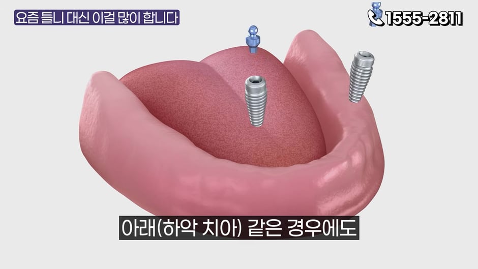 하악(아래턱) 임플란트 틀니 3D 그래픽 (영상 캡처)